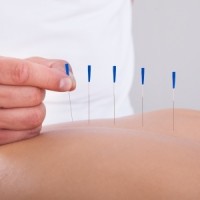 Acupuncture Toronto